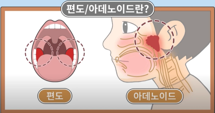 편도와-아데노이드-차이-그림
