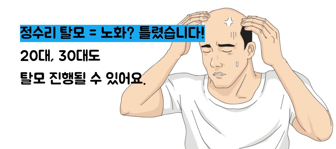 정수리 탈모