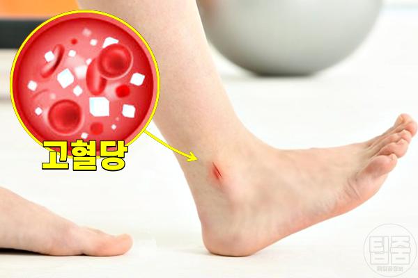 발이 보내는 위험한 신호 발 상처 당뇨병