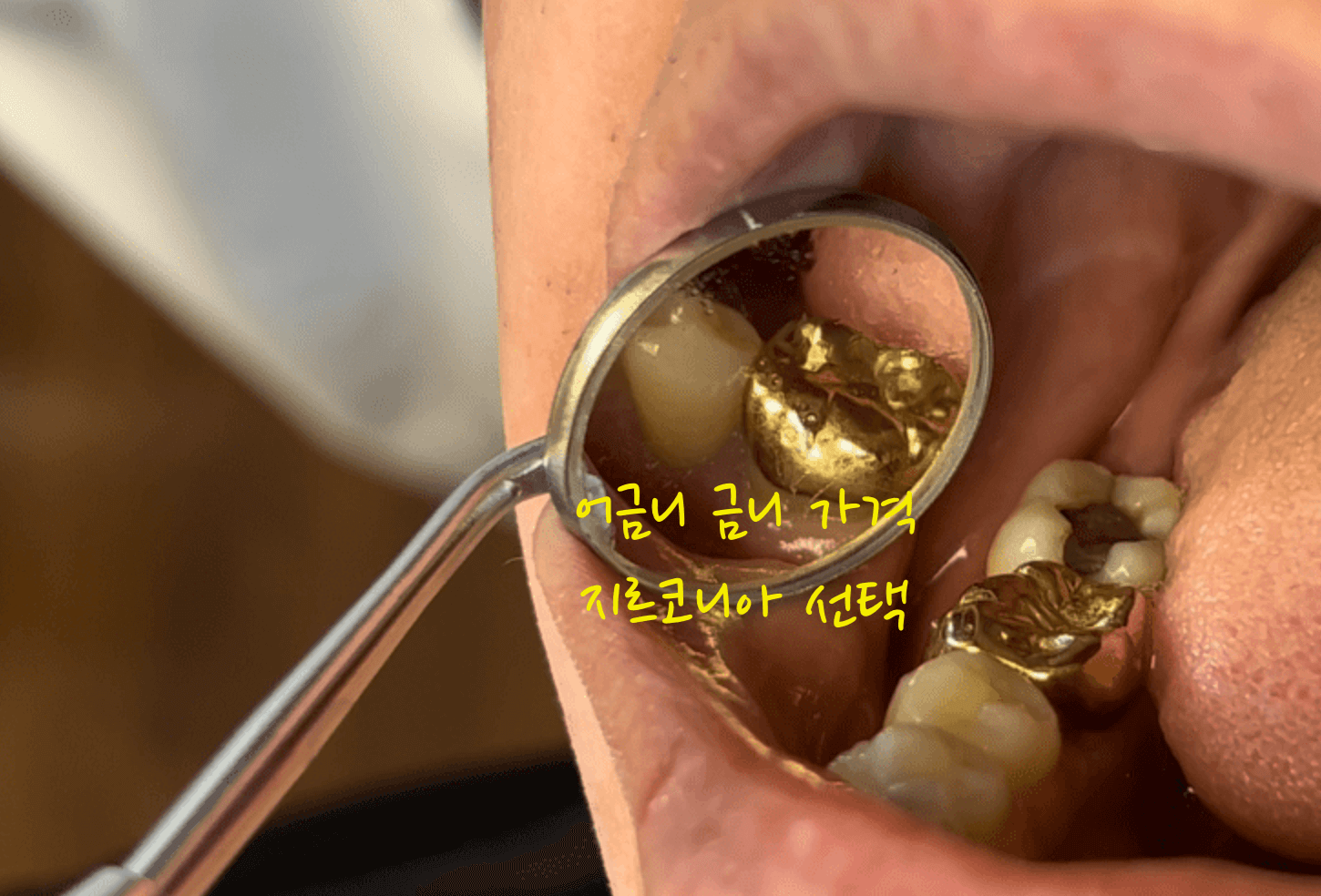 어금니 금니 가격