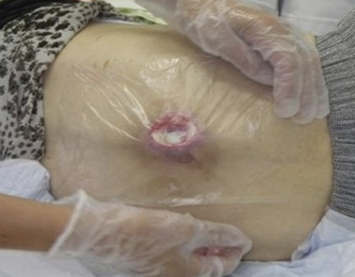 욕창 관리 기본 요약