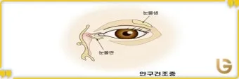 눈물이 자주 나는 이유에 대한 안과정보_12