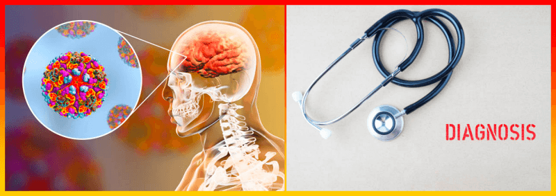 뇌척수염 발생 원인 이유