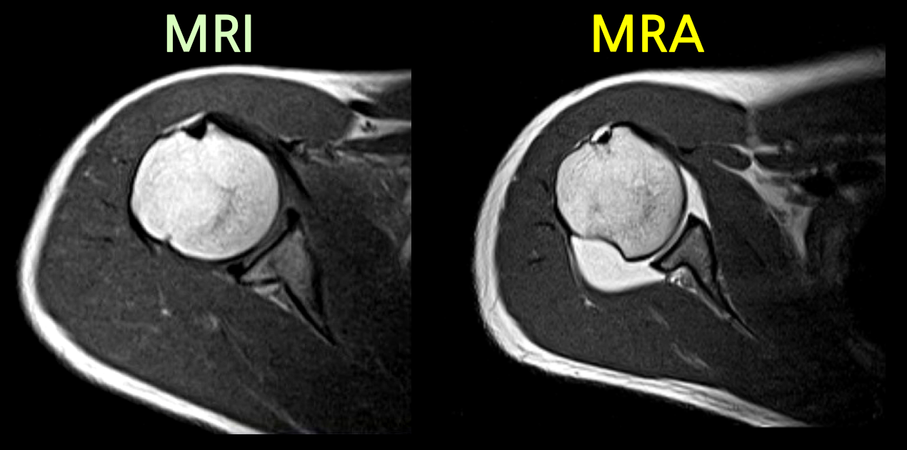 Shoulder-MRI-MRA