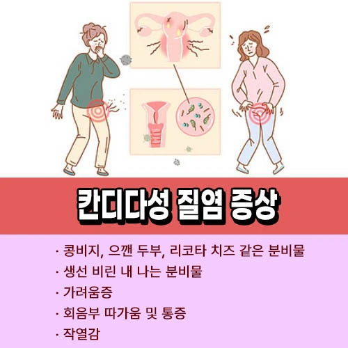칸디다성 질염 증상