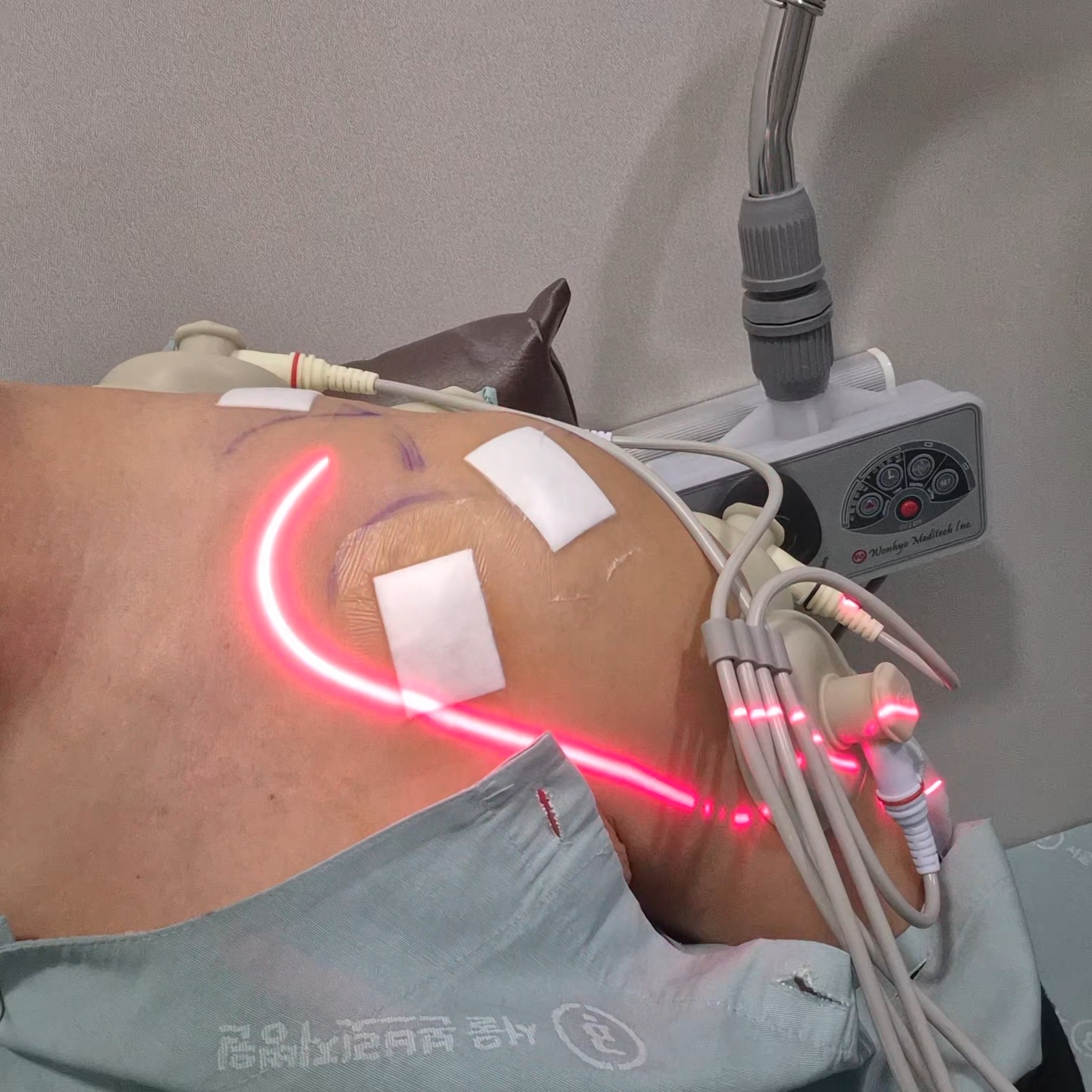 어깨 와순파열 봉합수술 후 mri사진 물리치료 기록