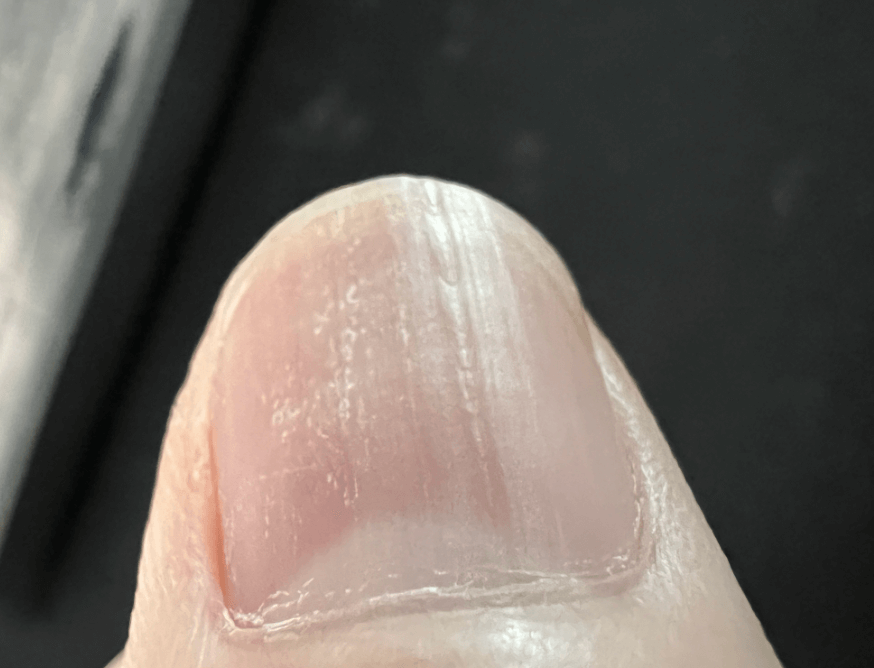 손톱 세로줄 울퉁불퉁