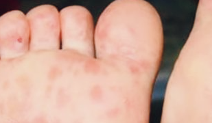 수족구병에 걸린 발바닥