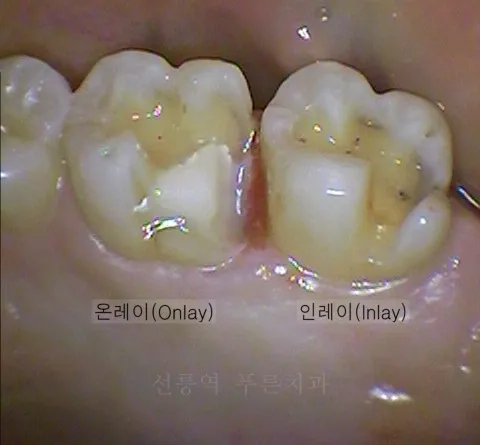인레이 온레이의 차이와 치료 방법_2