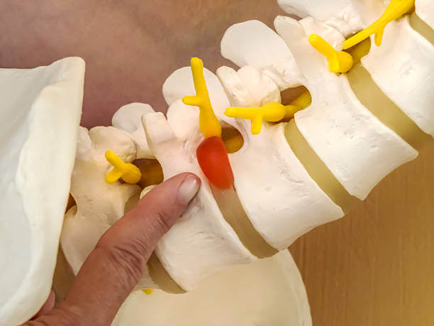 허리디스크 터지면 증상에 따라 수술여부를 판단하곤 합니다. 허리 디스크는 노화&amp;#44; 잘못된 자세&amp;#44; 반복적이고 과도한 움직임으로 인한 퇴행성 변화로 인해 발생합니다. 허리디스크가 터지면 수술을 해야 하는지 매우 고민스러운데요. 허리디스크 단계적인 증상과 치료 방법들을 알아봤습니다. 참고하시기 바랍니다.