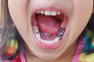 크라운-치료-가격