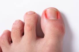 내성발톱 자가치료