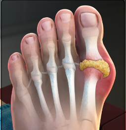 통풍 증상 - 발가락 통증