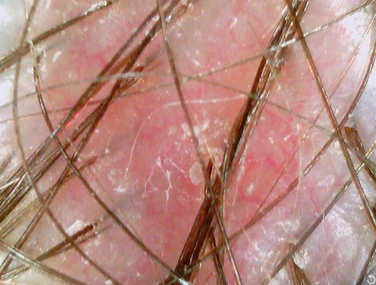 Captured before the head spa&amp;#44; this image reveals a scalp struggling with severe dryness and persistent flakiness. The lack of hydration has resulted in a hard&amp;#44; rigid scalp texture and congested pores&amp;#44; preventing essential nutrients from reaching the hair follicles.