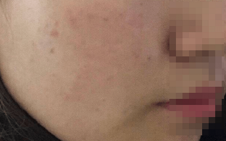 클라리티 레이저 시술 후 얼굴 상태