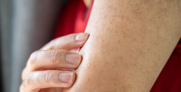 모공각화증 자주묻는질문 FAQ