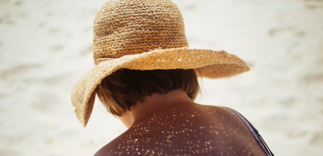 여름철 피부질환의 주요 원인