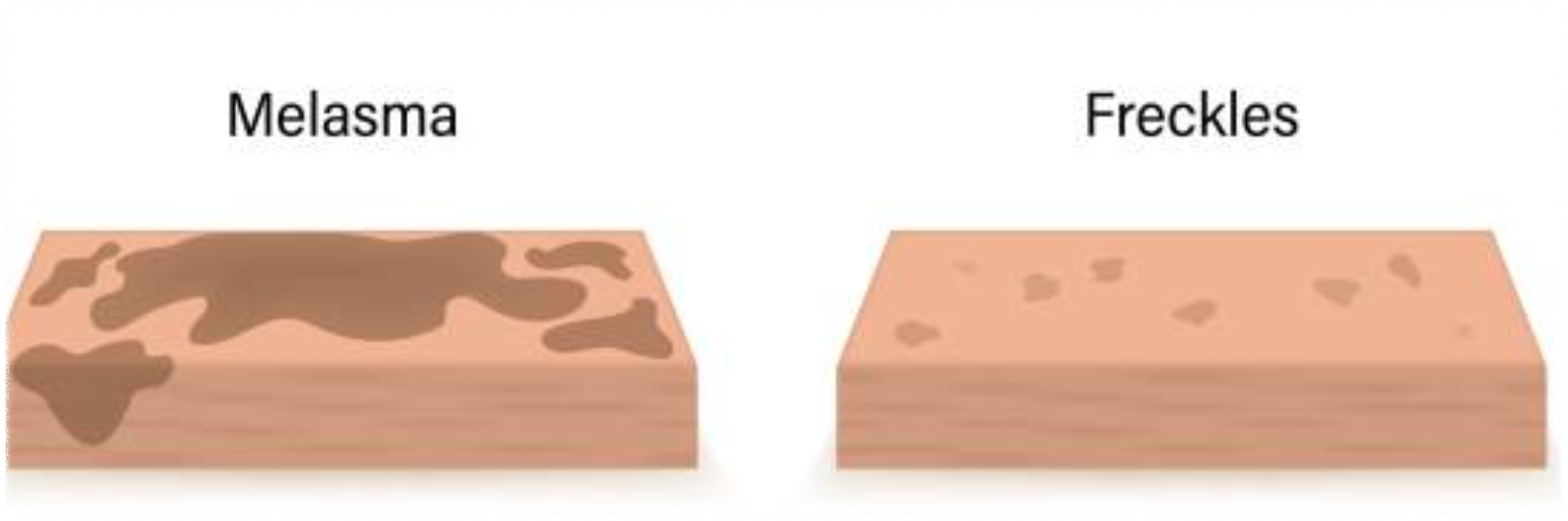 기미, 잡티 고민? 멜라논 크림 사용 후기부터 효과까지 솔직 리뷰