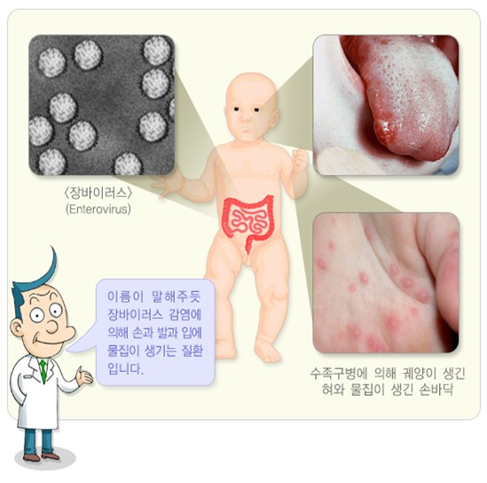 수족구, 수족구 증상, 수족구 초기 증상, 수족구 예방, 수족구 대처방법, 수족구 열, 수족구 수포