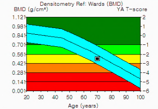골다공증 수치보는법