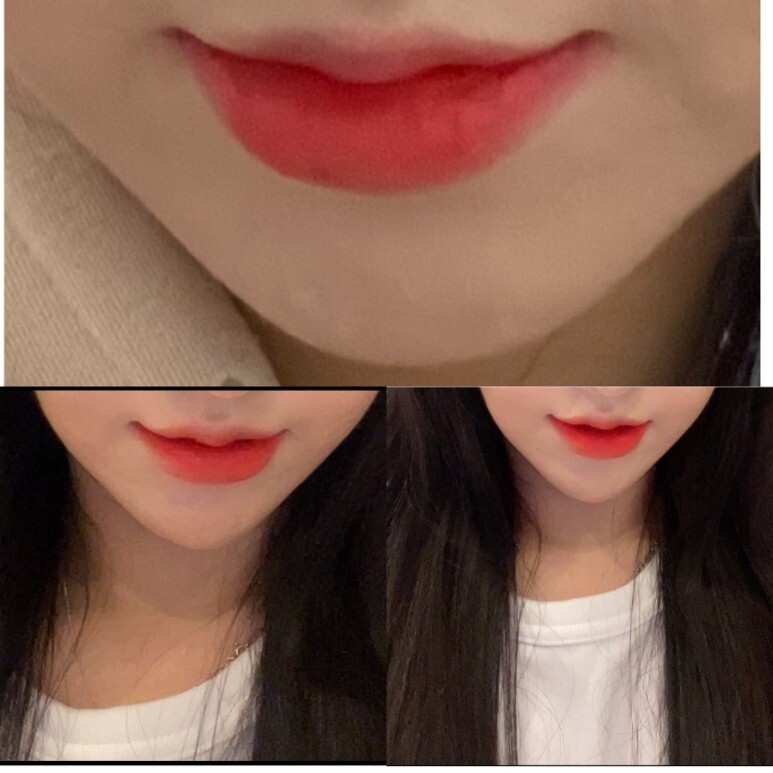 입술확대수술 후기