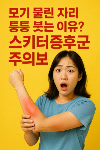 스키터증후군을 설명하기 위한 썸네일 이미지