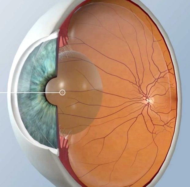 백내장 수술비용