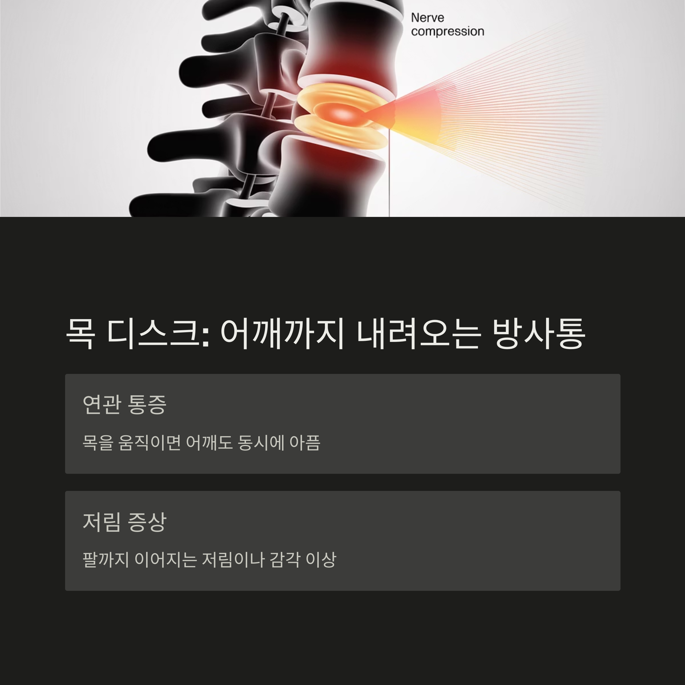 목 디스크로 인한 어깨 방사통과 팔 저림 증상을 보여주는 디스크 신경 압박 구조 이미지