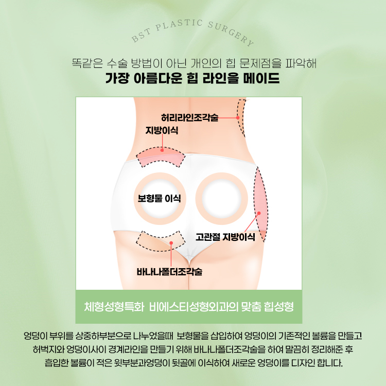 엉덩이 부위를 상중하부분으로 나누었을때 보형물을 삽입하여 엉덩이의 기본적인 볼륨을 만들고 허벅지와 엉덩이 사이 경계 라인을 만들기 위해 바나나폴더 조각술을 하여 말끔히 정리해준 후 흡입한 볼륨이 적은 윗부분과 엉덩이 뒷골에 이식하여 새로운 엉덩이를 디자인합니다.