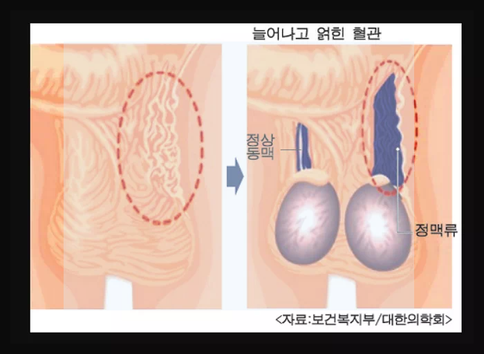 정계 정맥류란