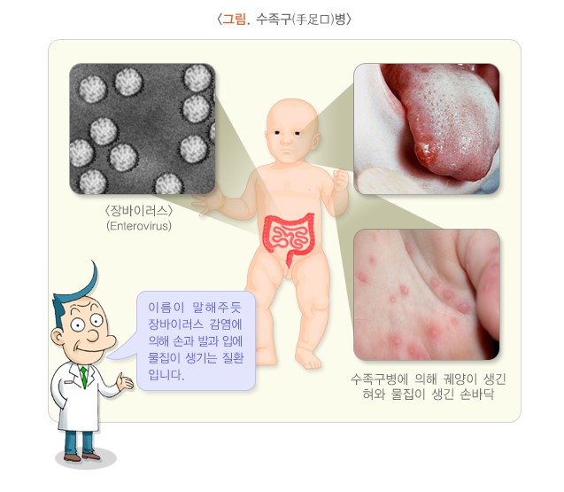 수족구 수포 사진
