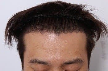 모발이식 후기