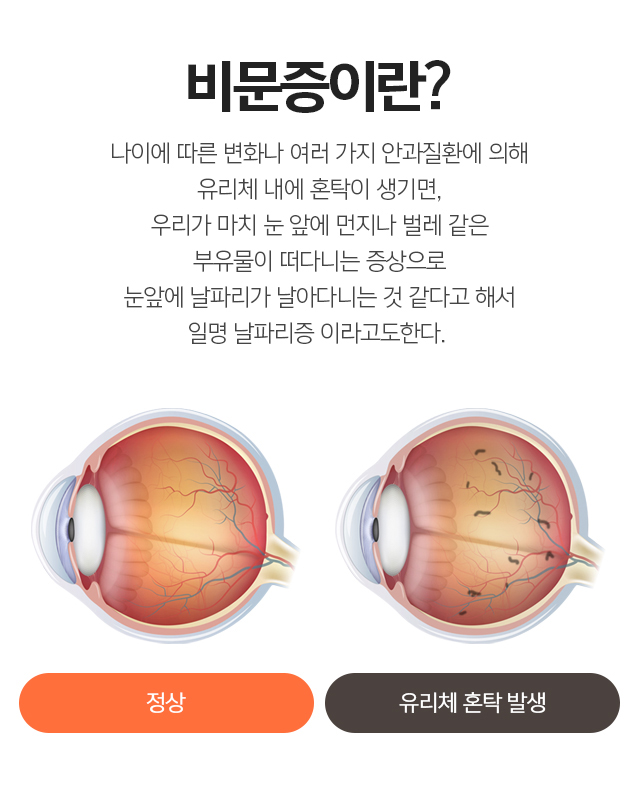 비문증