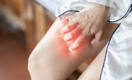 하지 정맥류 증상 12