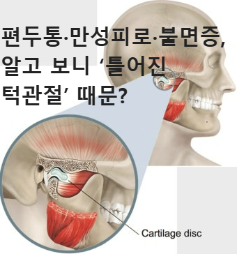 편두통·만성피로·불면증, 알고 보니 ‘틀어진 턱관절’ 때문?