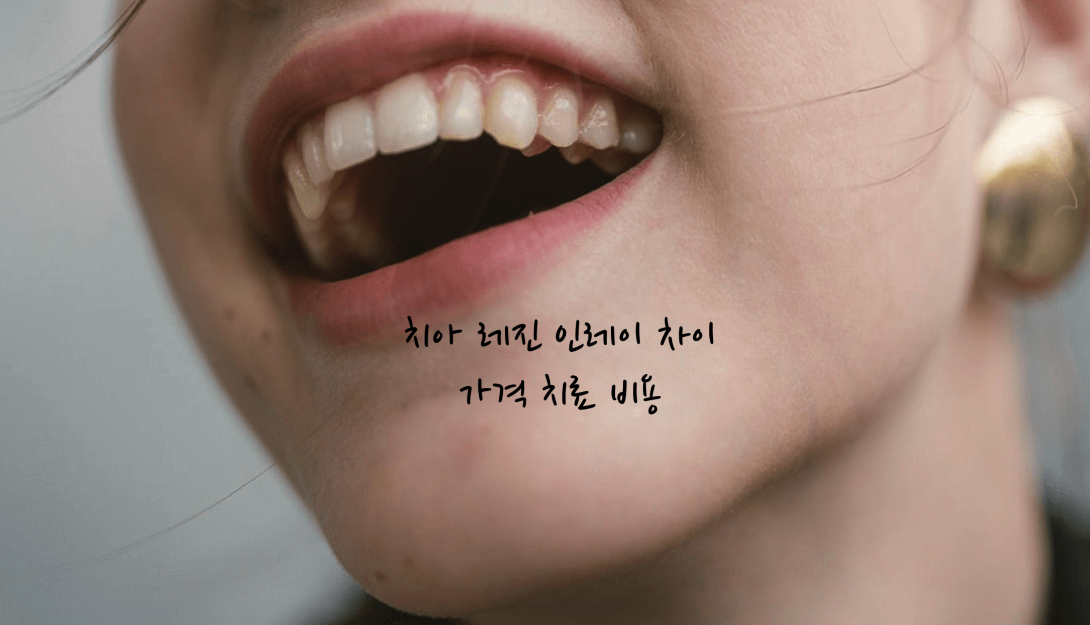 레진 인레이 차이