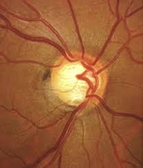 녹내장 초기증상 원인 치료방법