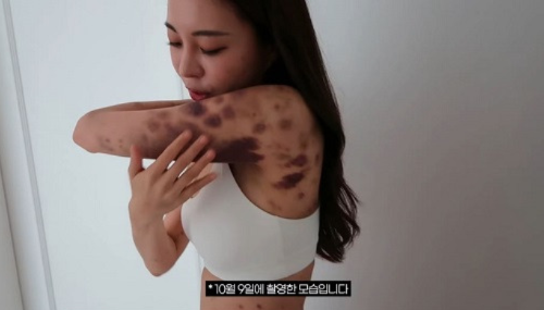 아옳이 유튜브에 공개한 멍든 사진