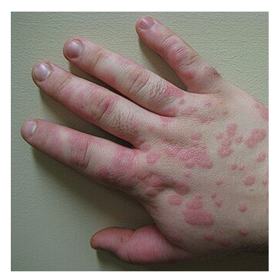 다형홍반과 관련된 사진입니다.