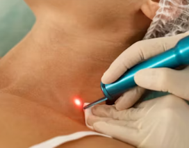 쥐젖 제거방법 가장 안전한 제거방법