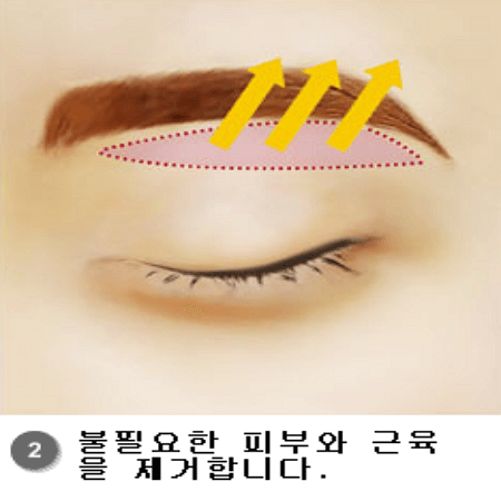 눈썹거상술 두번째 단계