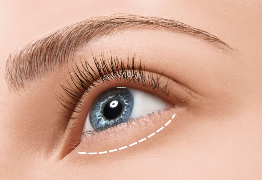 하안검 수술비용