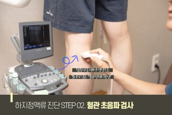 하지정맥류 진단