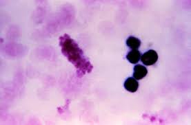 혈소판 수치 올리는 방법