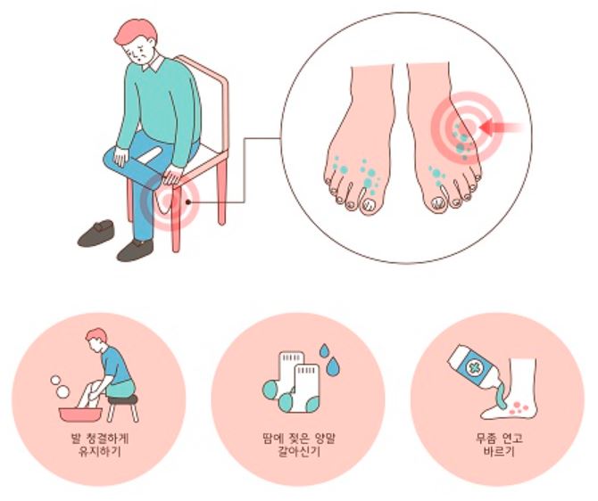 무좀 치료 실패, 재발 원인