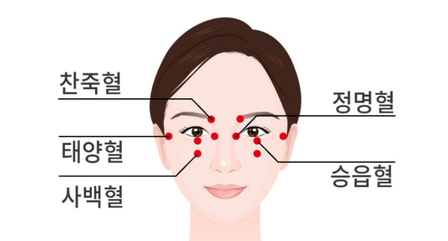 인체의 365혈 중에서 얼굴에 위치를 한 정명, 찬죽, 승읍, 사백, 태양 경혈의 위치를 빨간 점으로 표시해 놓은 이미지 사진