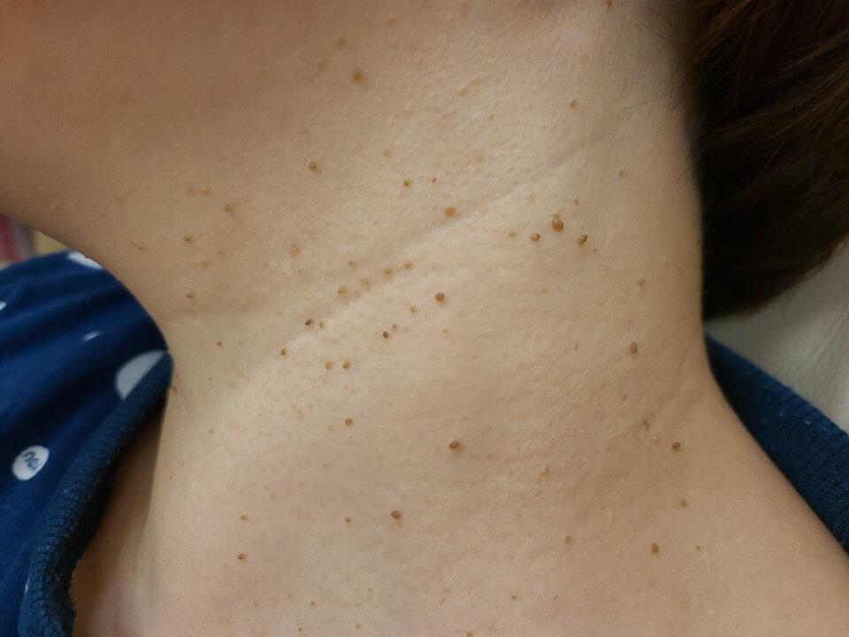 쥐젖이 생기는 이유