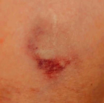 멍이 잘 드는 이유와 오래가는 이유&amp;#44; 병일까?