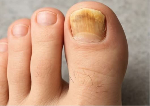 발톱무좀 증상