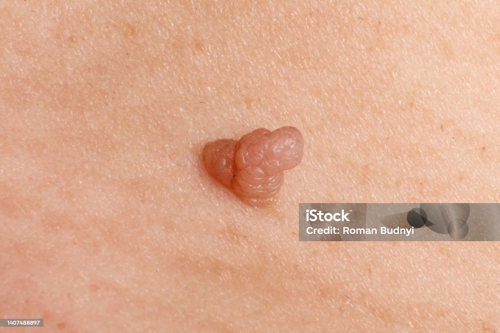 쥐젖은 피부과에 방문해 제거하는 것이 가장 좋다